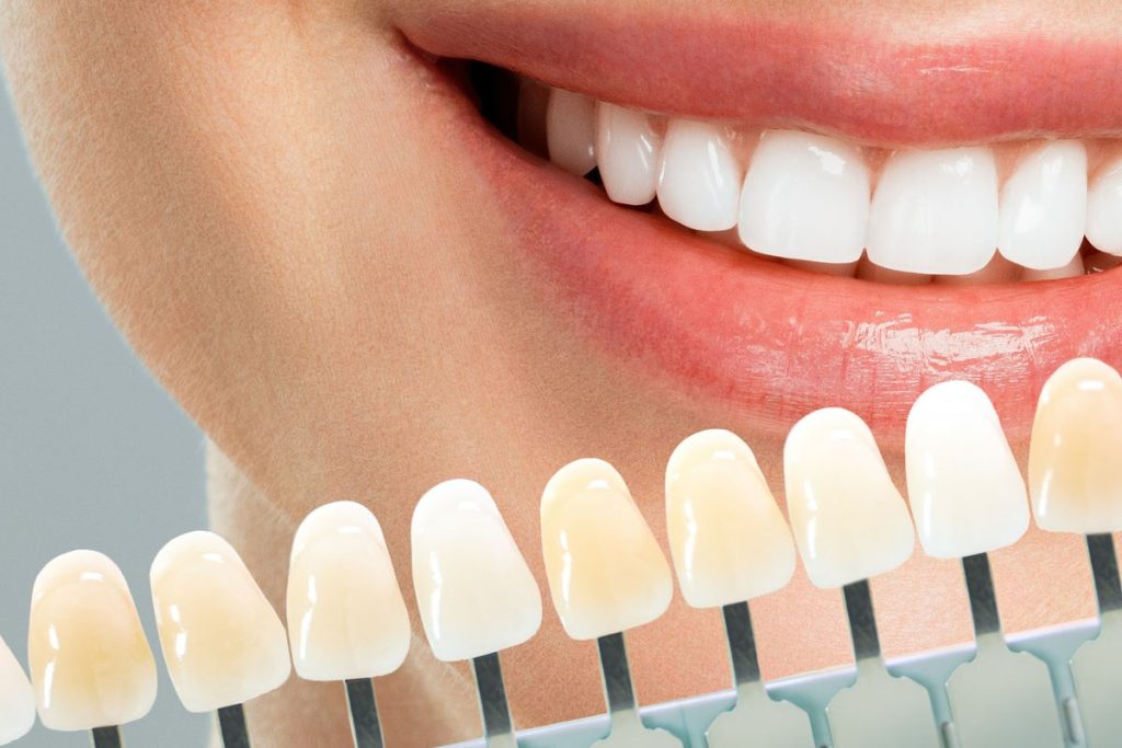 Composite Bonding in New Brighton