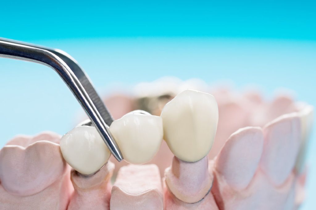 Crowns and Bridges in New Brighton, MN