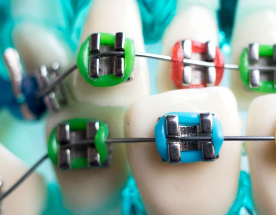 What is the Difference Between Braces and Invisalign