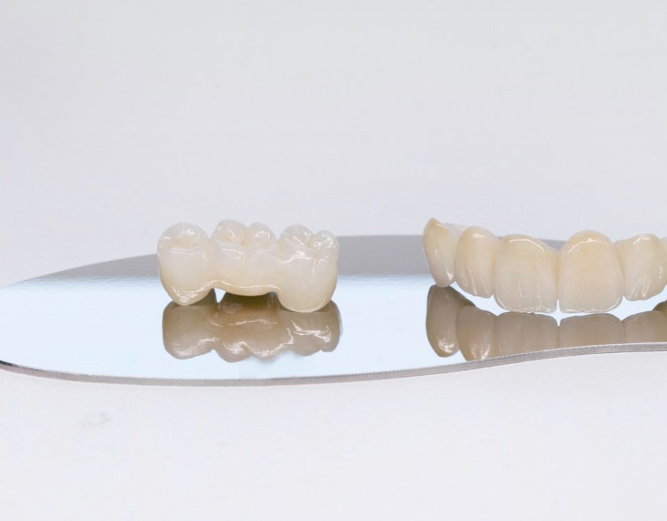 Different Types of Dental Bridges