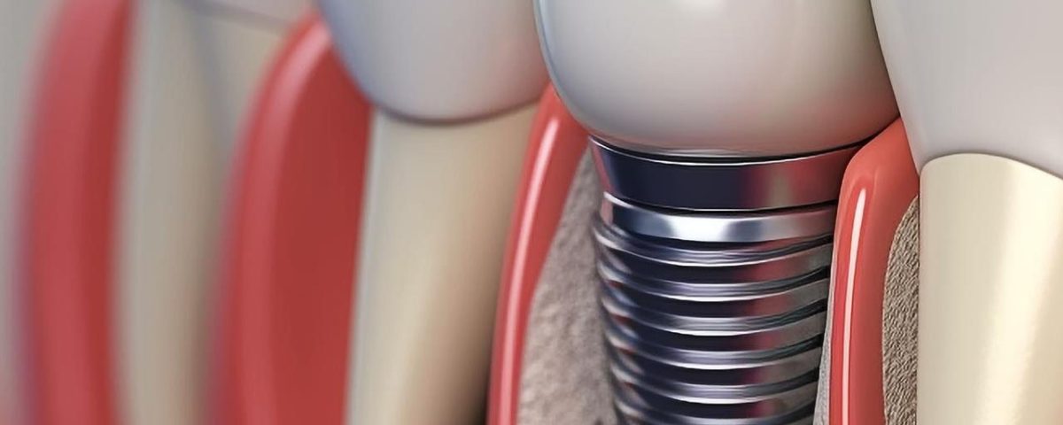 How Long Does a Dental Implant Procedure Take?
