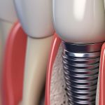 How Long Does a Dental Implant Procedure Take?