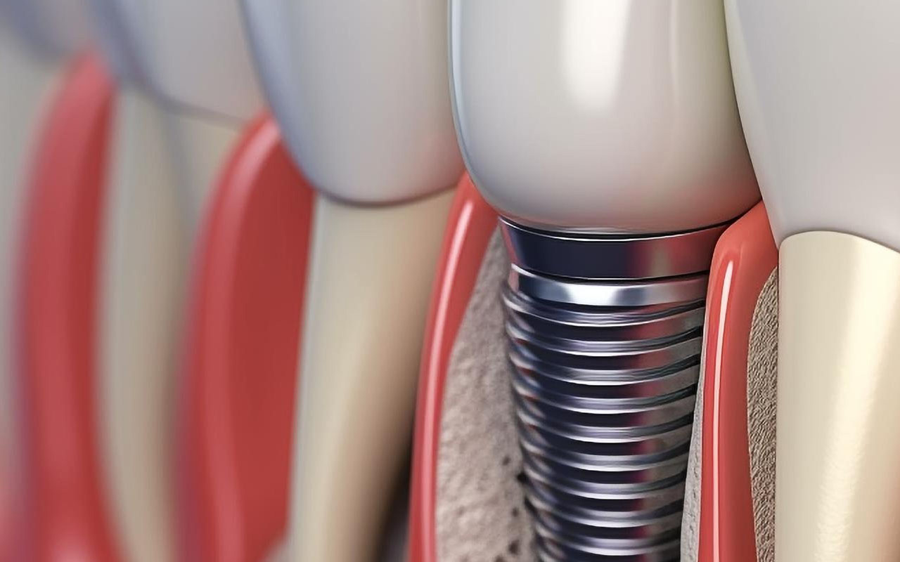 How Long Does It Take for a Dental Implant Procedure?