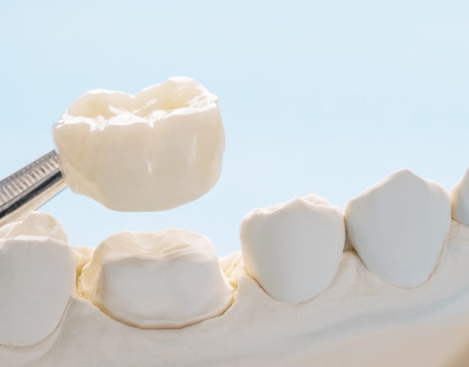 What are the Different Types of Dental Crowns?