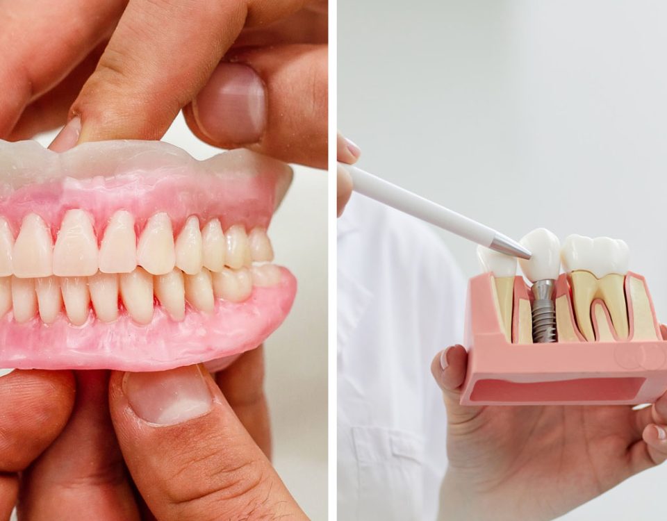 Dental Implants vs. Dentures How to Choose