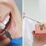 Dental Implants vs. Veneers What is the Best Option