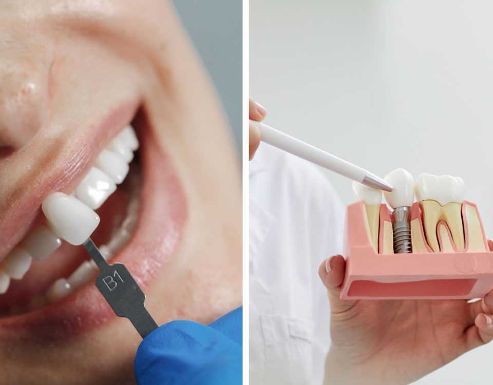 Dental Implants vs. Veneers What is the Best Option
