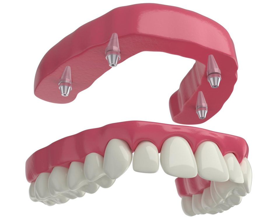 Full Mouth Dental Implants and Full Arch Implants Types and Differences