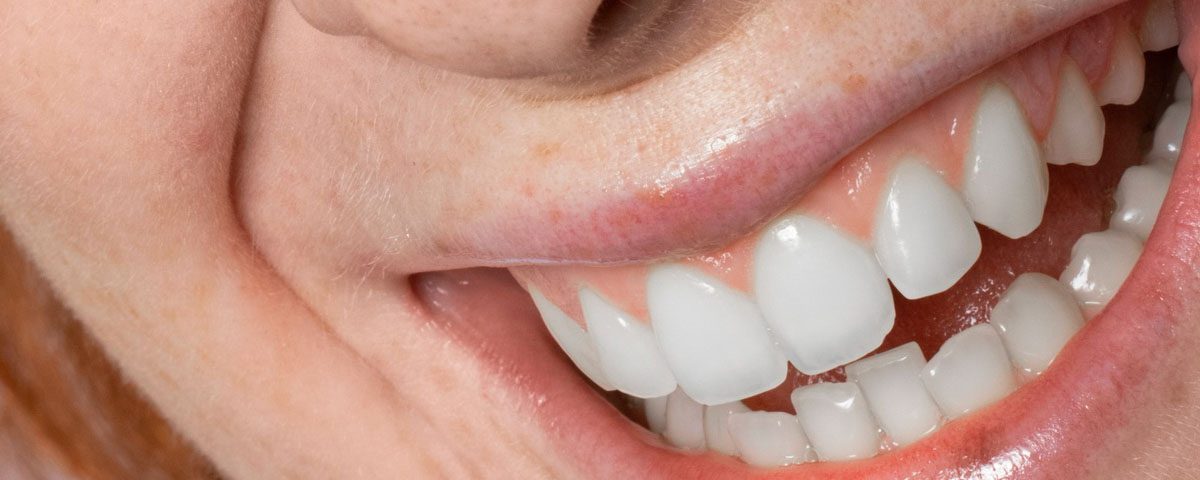 How to Fix Bad Composite Bonding