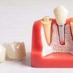 Tooth Implant vs. Dental Bridge Pros and Cons & Differences