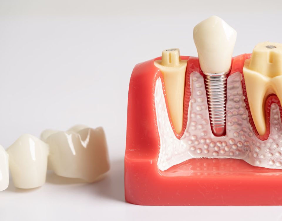 Tooth Implant vs. Dental Bridge Pros and Cons & Differences
