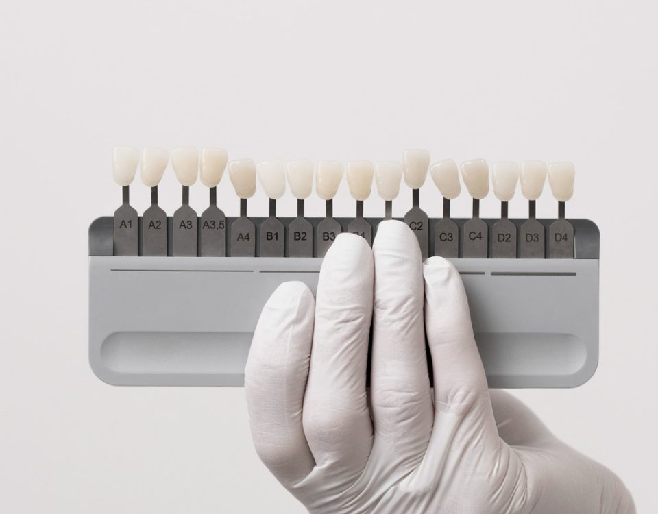 Can You Whiten Your Teeth if You Have Composite Bonding
