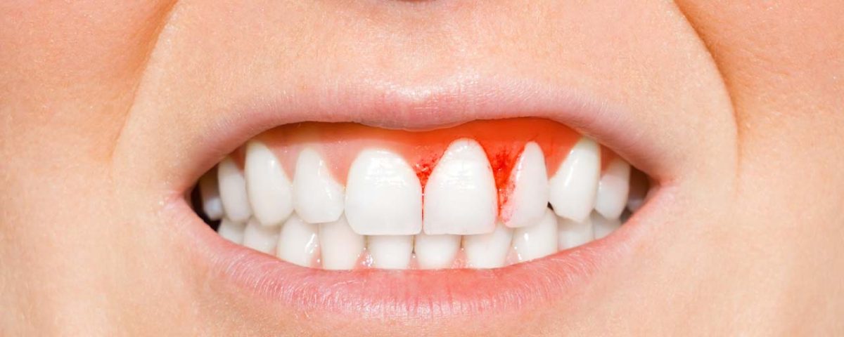 Periodontal Disease Self-Care Tips to Cure Periodontal Disease at Home
