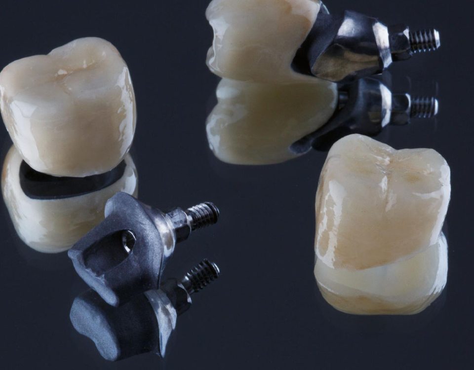 What are the Different Types of Dental Implant Crowns