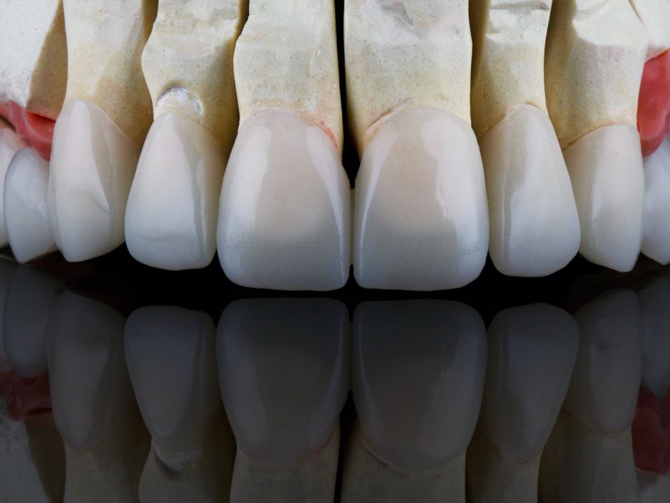 Porcelain Veneer vs. Composite Veneer Which is Better
