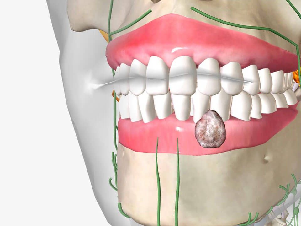 What is Oral Cancer Screening