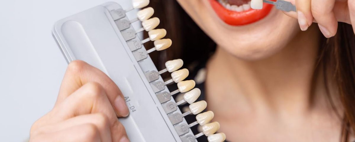 Are Dental Veneers Worth It