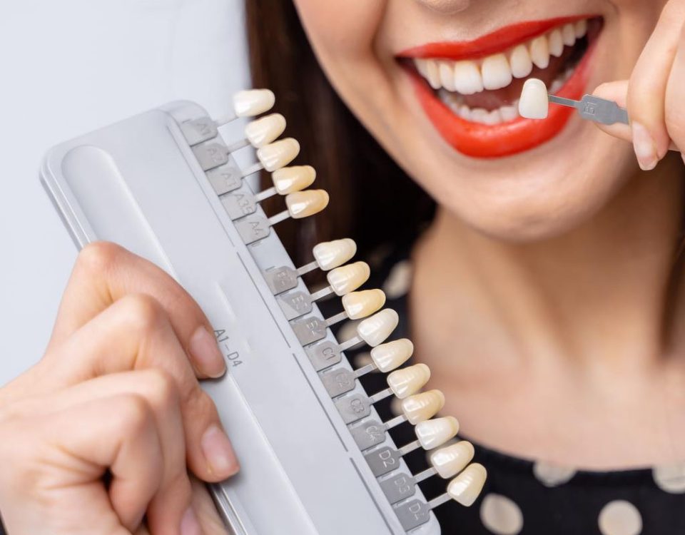 Are Dental Veneers Worth It