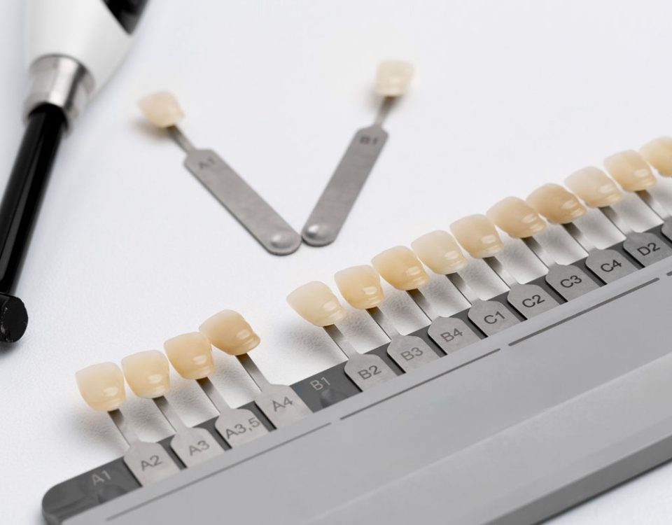 Dental Bonding vs. Veneers What You Didn’t Know!