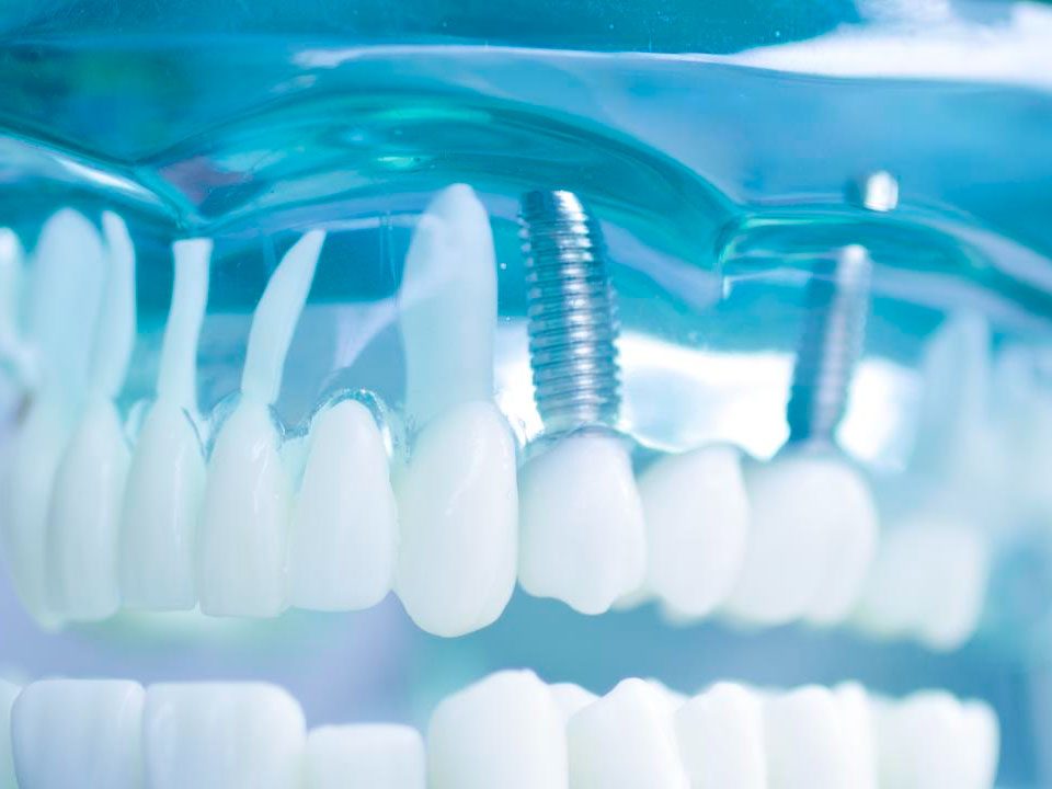 When Is It Too Late to Get Dental Implants