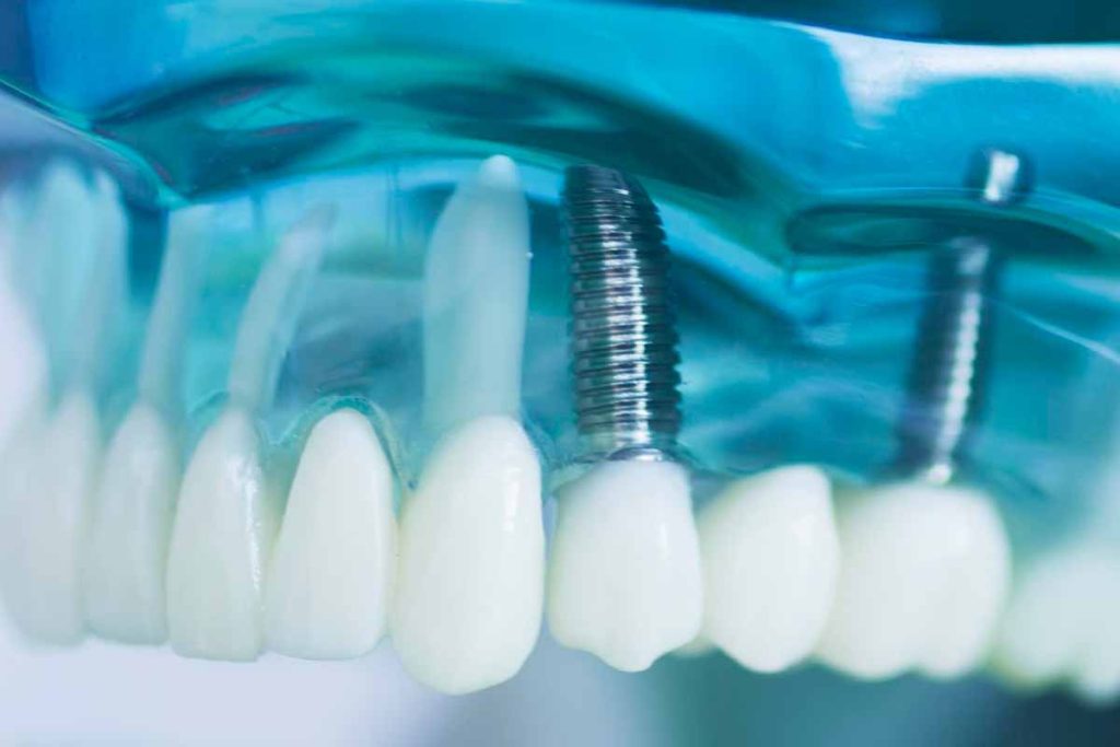 Affordable Dental Implants Near Me in New Brighton, Minnesota