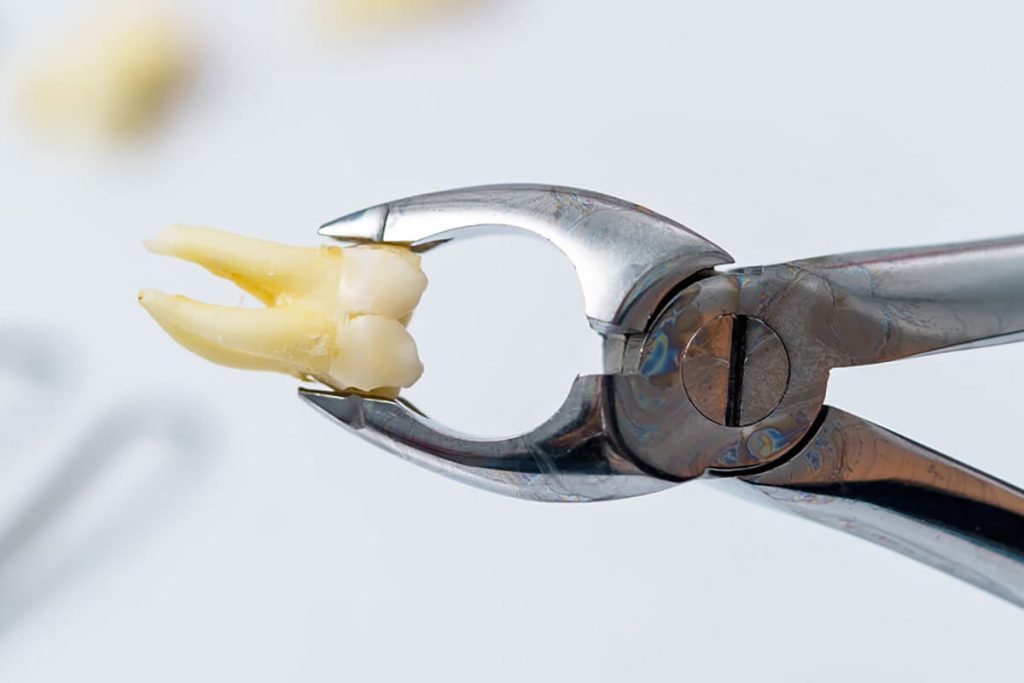 Affordable Tooth Extractions New Brighton, MN - Services