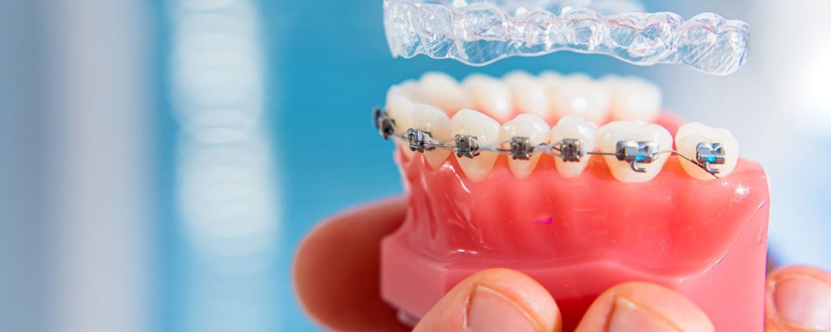 Can I Switch from Invisalign to Braces Mid-Treatment