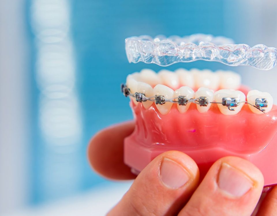 Can I Switch from Invisalign to Braces Mid-Treatment