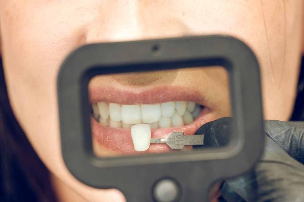 Composite Dental Bonding Near Me in New Brighton, Minnesota