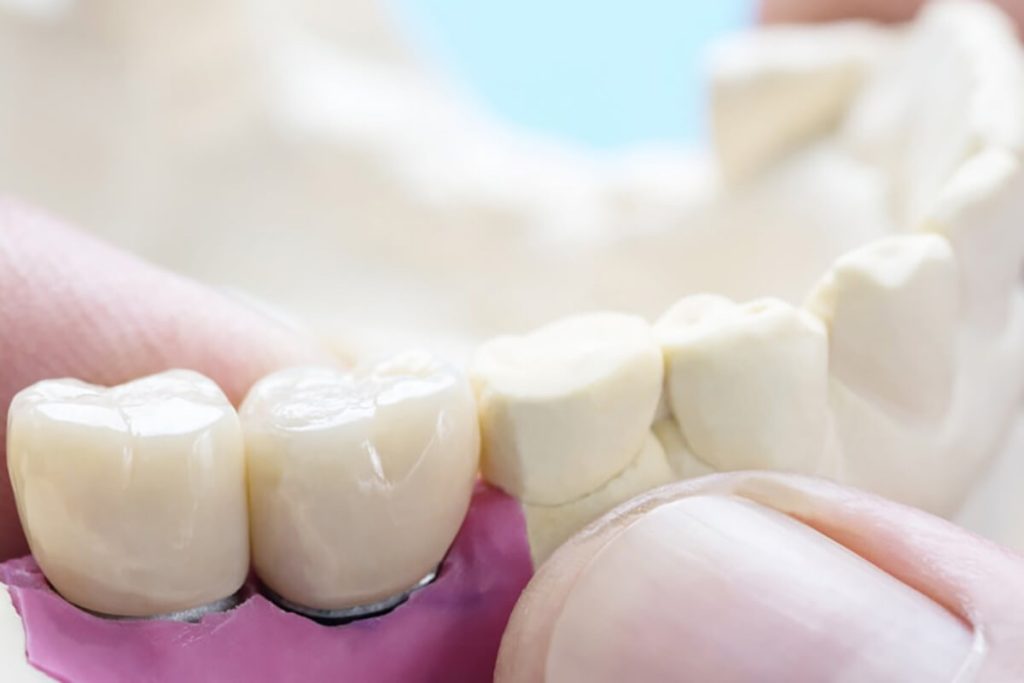 Dental Bridges in New Brighton, MN - Services