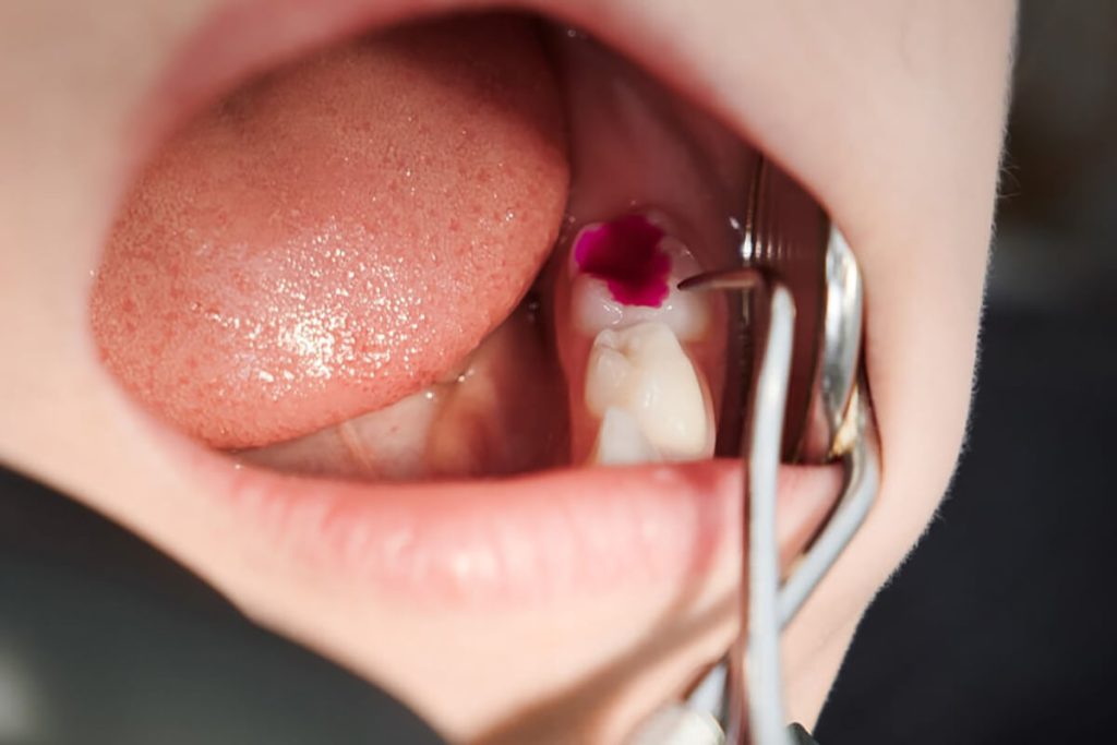 Dental Fillings New Brighton, MN - Services