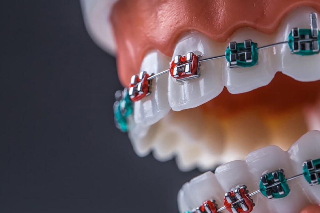 Orthodontist New Brighton, MN - Services