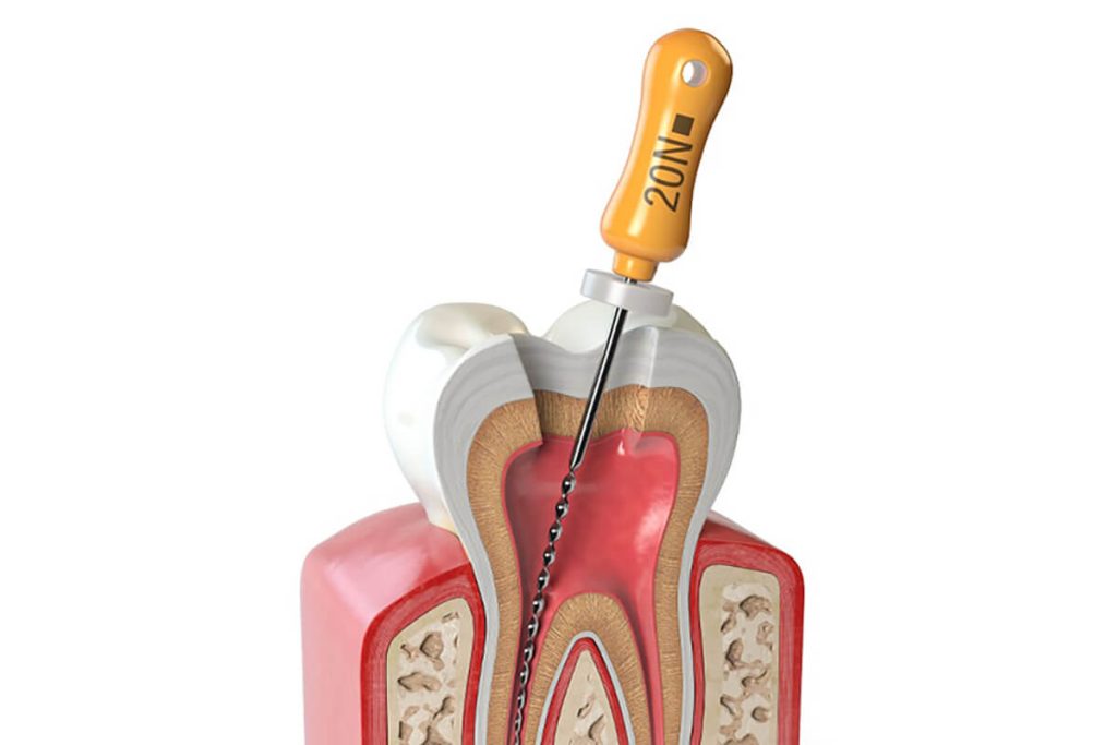 Root Canal New Brighton, MN - Services
