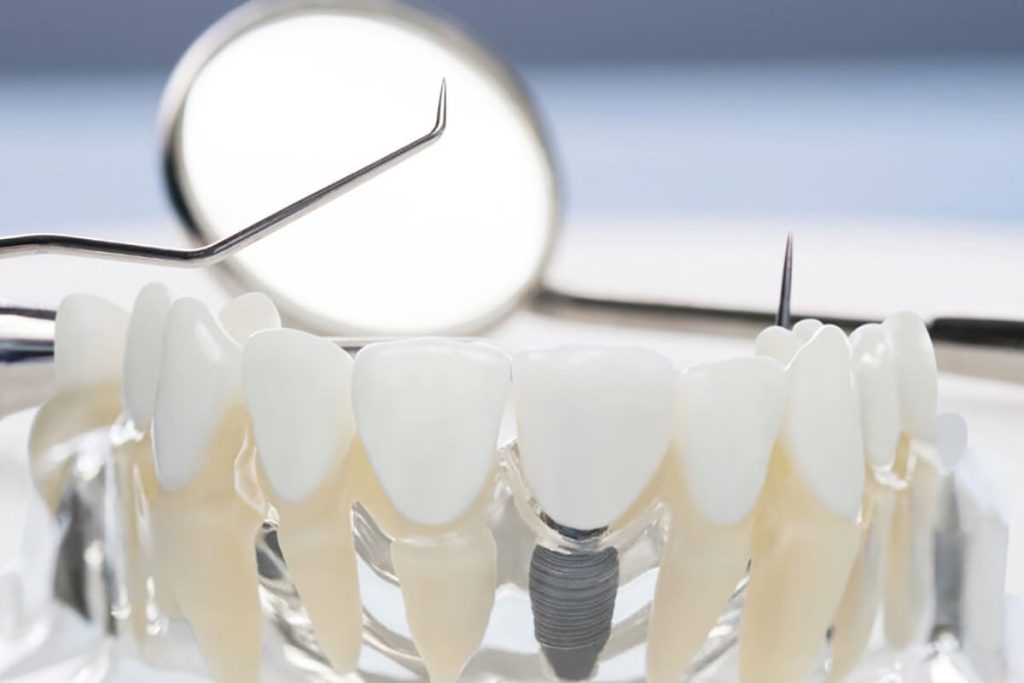 Single Tooth Implants New Brighton, MN - Services