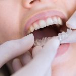 Do You Really Need a Retainer After Invisalign Treatment?