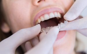Do You Really Need a Retainer After Invisalign Treatment?