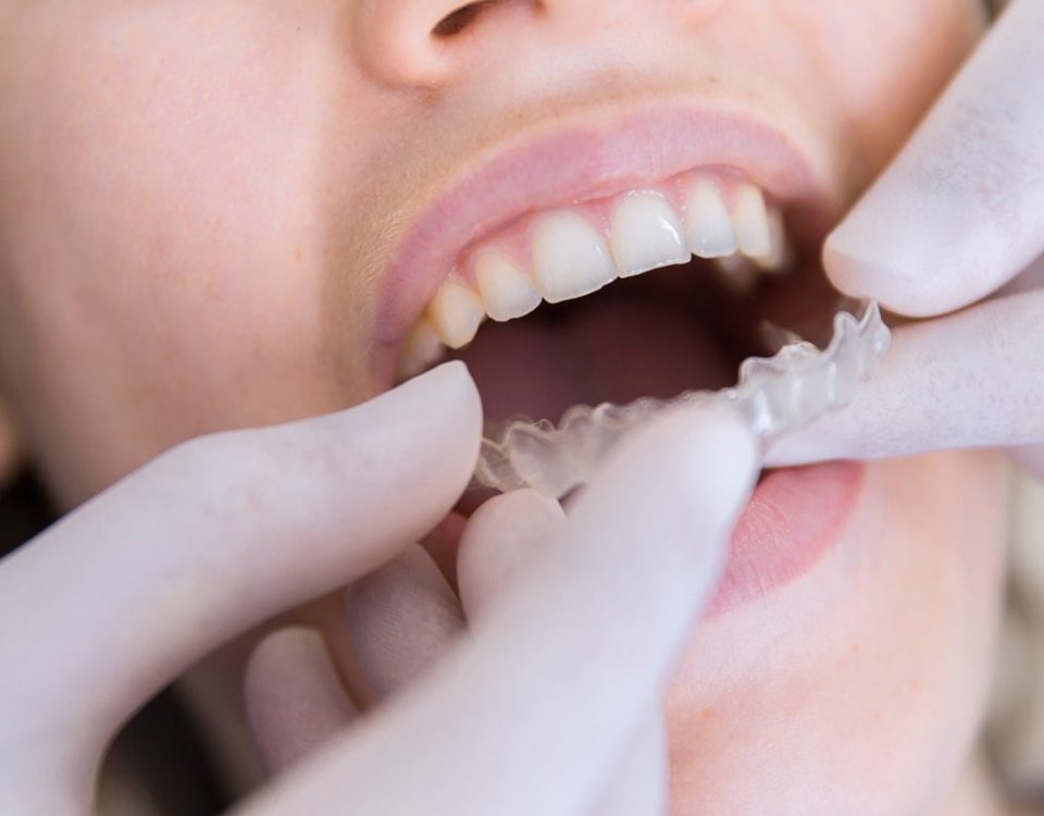 Do You Really Need a Retainer After Invisalign Treatment?